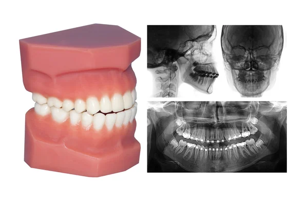 Modelo de dentes e raio-x cefalométrico isolado no withe — Fotografia de Stock