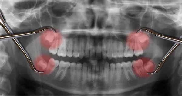 Vier Weisheitszähne im Röntgenbild — Stockfoto