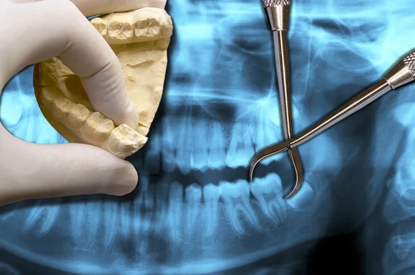 Simulation of molar teeth extraction — Stock Photo, Image