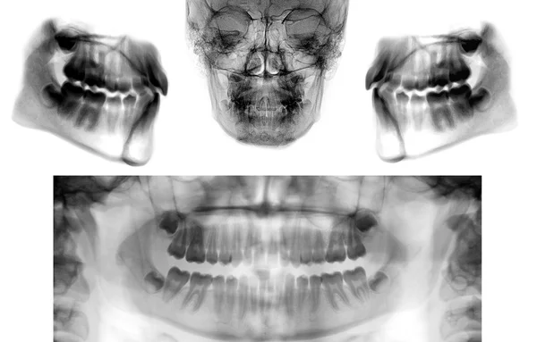 パノラマ歯科用 x 線のセット — ストック写真