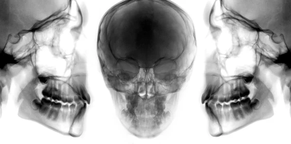 Set of X-ray skull — Stock Photo, Image