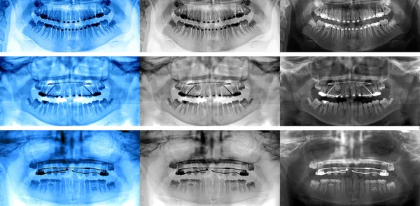 Scanare dentară, tipuri de aparate fixe — Fotografie, imagine de stoc