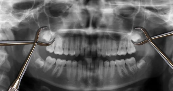 Orthodontic tools and wisdom teeth — Stock Photo, Image