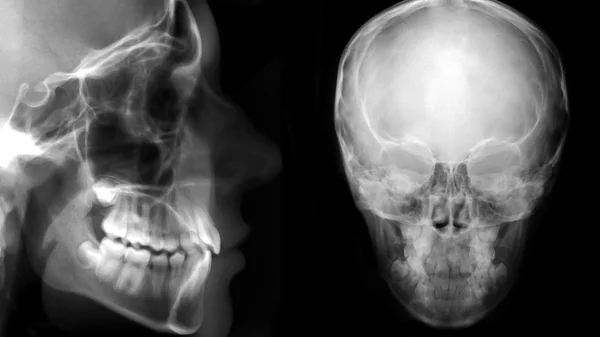 Digital cephalometric, frontal and lateral x-ray — Stock Photo, Image