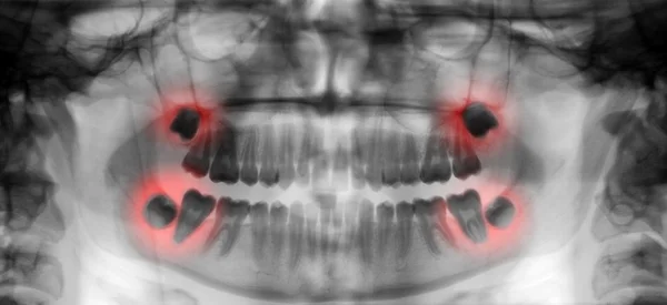 Radiografía de exploración dental — Foto de Stock