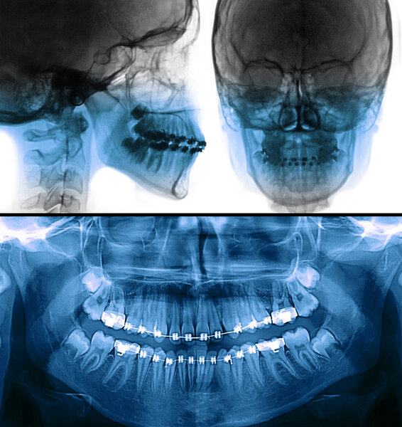 fixed appliance x-ray, orthodontic treatment
