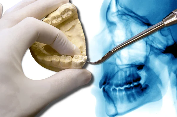 Orthodontics tool show molar tooth over x-ray — Stock Photo, Image