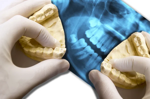 Hands show molar teeth over x-ray dental scan — Stock Photo, Image