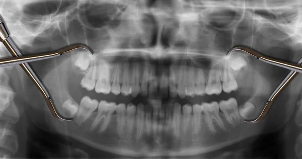 Ferramenta ortodôntica sobre raio-x varredura dentária mostrar dentes sabedoria — Fotografia de Stock