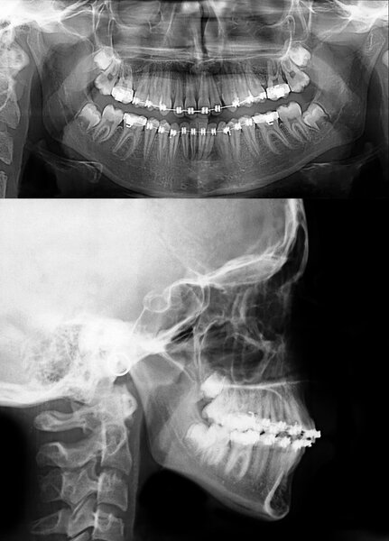 fixed appliance with brackets, radiography