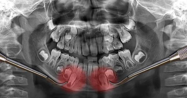 Αυξανόμενη δόντια, οδοντιατρική ακτινογραφία σάρωσης — Φωτογραφία Αρχείου