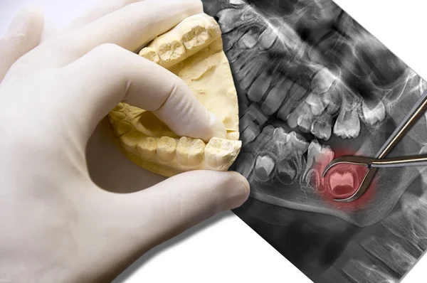 Hand show molar tooth and toothache wisdom tooth — Stock Photo, Image