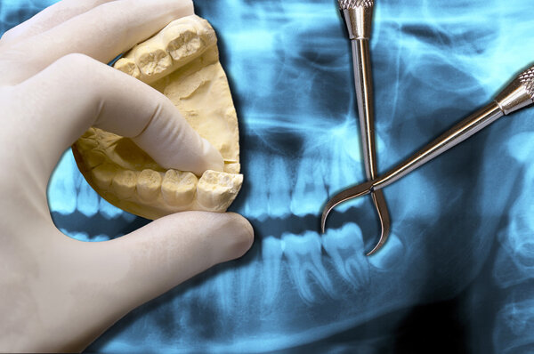 molar teeth extraction