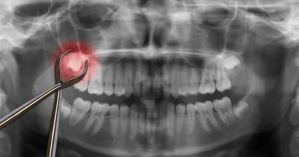 Orthodontische gereedschap Toon wijsheid kiespijn — Stockfoto