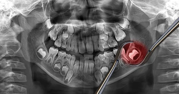 X-ray dental scanning: visdom tand - Stock-foto