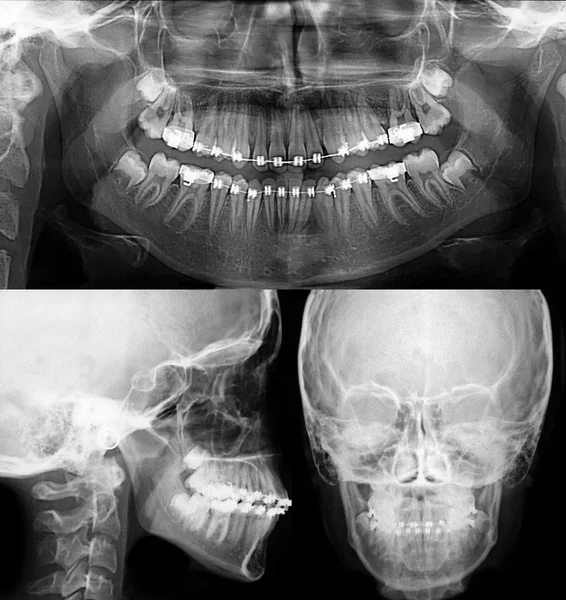 Raio-x com braquetes dentários, tratamento ortodôntico — Fotografia de Stock
