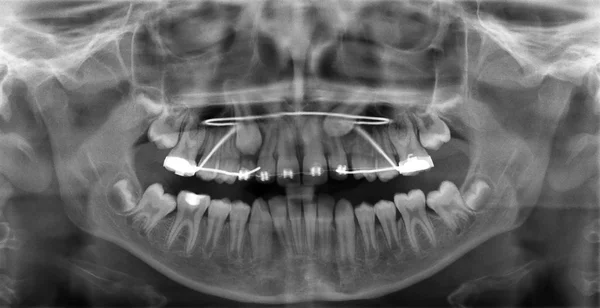 X-ray met vaste toestel — Stockfoto