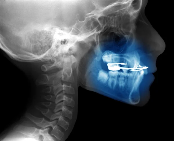 Рентген с фиксированным прибором, используемым для ортодонтического лечения — стоковое фото
