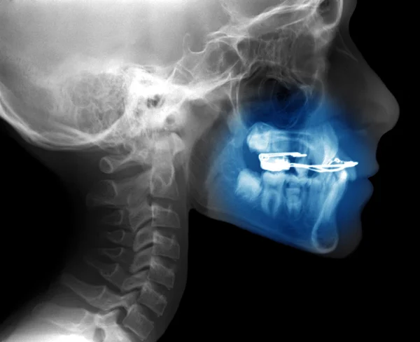 고정된 기기 교정 치료에 사용 된 x 선 — 스톡 사진