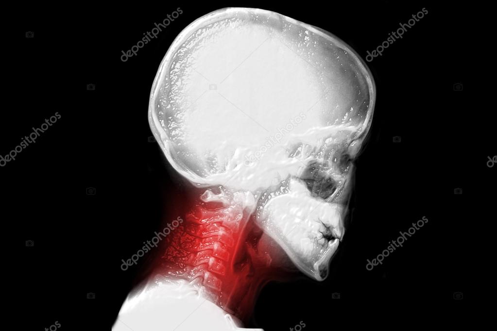 human cervical vertebrae, neck pain