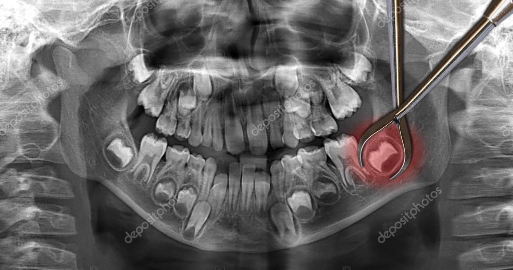 Dental scan wisdom teeth — Stock Photo © mkarco 104749106