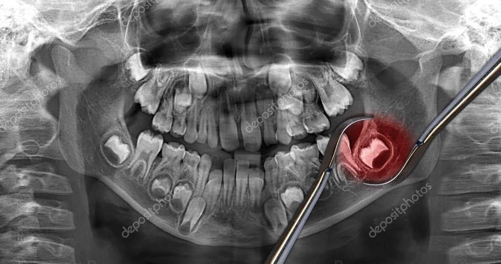 X Ray Dental Scan Wisdom Tooth — Stock Photo © Mkarco 104749506