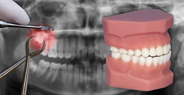 Simulación de extracción quirúrgica, sobre exploración dental —  Fotos de Stock