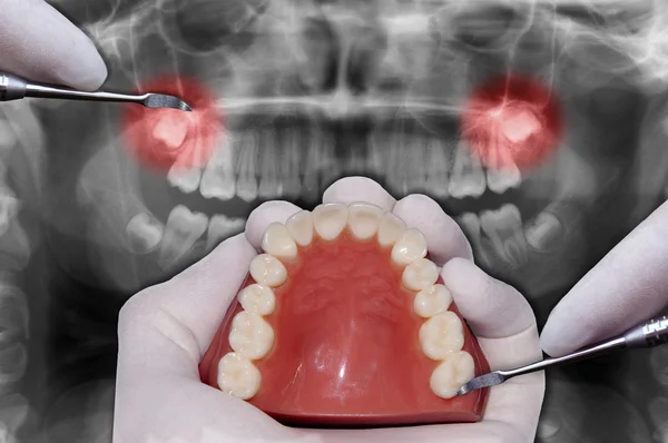 Dentist hand simulates dental surgery — Stock Photo, Image