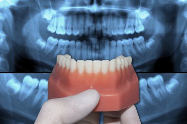 showing lower dental arch over panoramic radiograpghy clipart