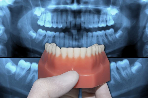 Mostrando arco dental inferior sobre radiografía panorámica —  Fotos de Stock