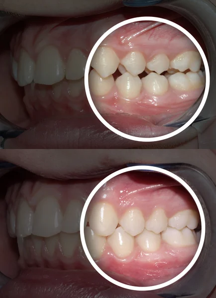 Malocclusie na en voor orthodontische behandeling — Stockfoto