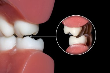 dental occlusion molars teeth close up clipart