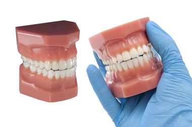 Diş görünmez Ortodonti çıkarılabilir aligners