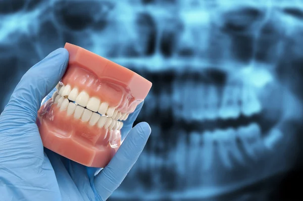 Οδοντίατρος χέρι δείχνουν οδοντιατρική καλούπι χαμογελά πάνω από αξονική τομογραφία οδοντιατρική — Φωτογραφία Αρχείου