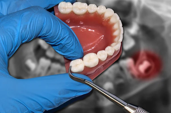 Стоматолог показывает зуб зуба и зуб мудрости контакт — стоковое фото