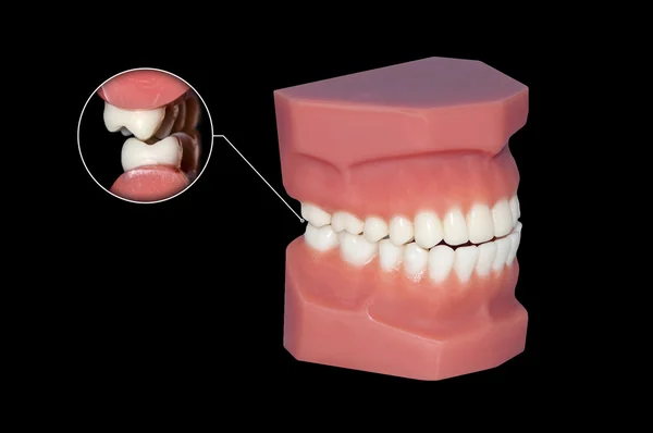 Gnashing of teeth dental molars illustration — Stock Photo, Image