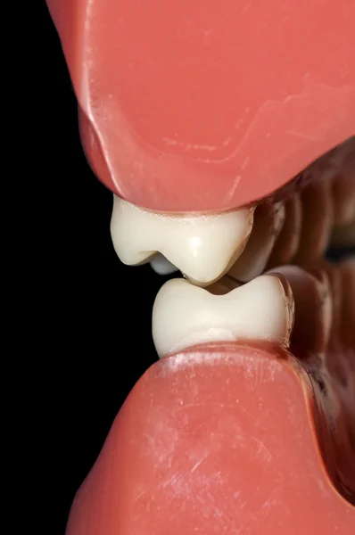 歯の噛み合わせ臼歯歯面の接触します。 — ストック写真