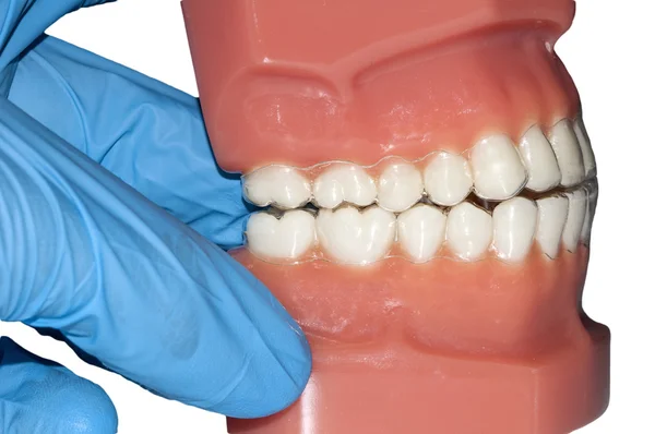 Dental cast with invisible orthodontic removable aligners — Stock Photo, Image