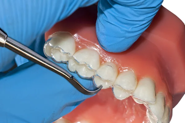 Appareils orthodontiques invisibles aligneur amovible — Photo