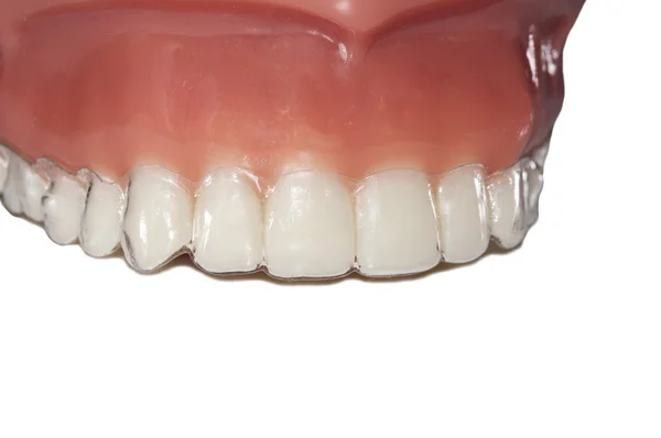 Aparatos de ortodoncia invisibles alineadores extraíbles —  Fotos de Stock