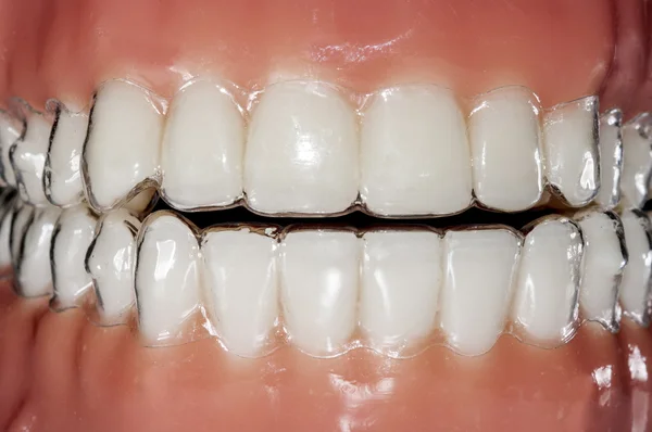 치아 치료에 대 한 보이지 않는 및 이동식 aligners — 스톡 사진