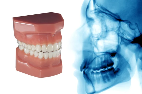 Tanden mal met onzichtbare orthodontische verwisselbare aligners en cephalometric — Stockfoto