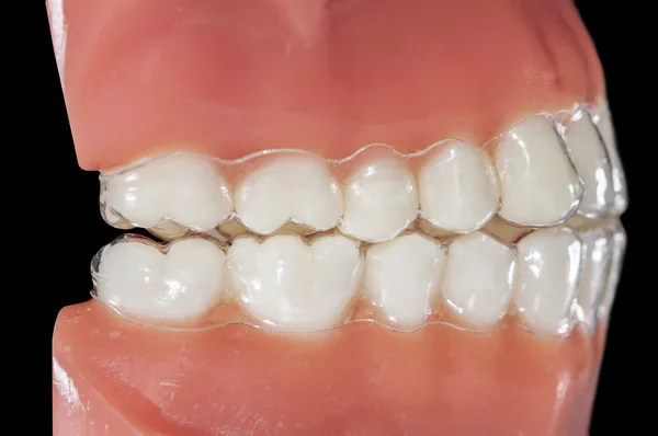 Neviditelný ortodontické vyměnitelné aligners pro Bruxismus léčba — Stock fotografie