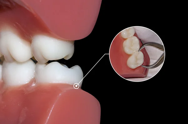 Cirurgia odontológica extração informações infográficas médicas — Fotografia de Stock