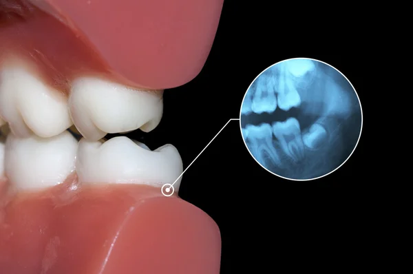 Fogászati diagnosztika xrays fogak fogfájás grafikus — Stock Fotó