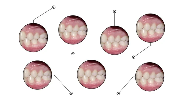 Oclusión dental elementos infopráficos médicos formas — Foto de Stock