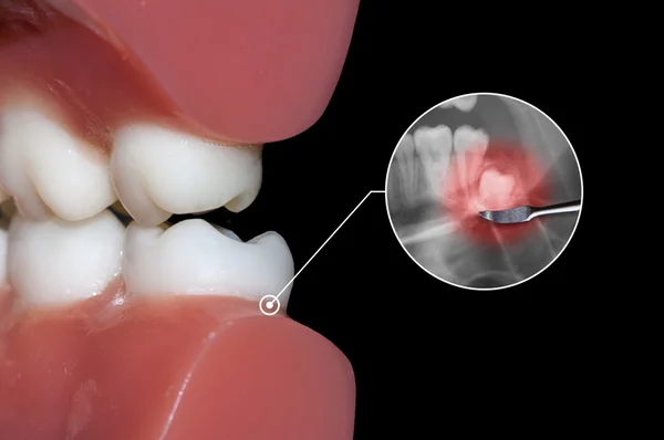 Dental toothache, wisdom tooth and molar impact — Stock Photo, Image