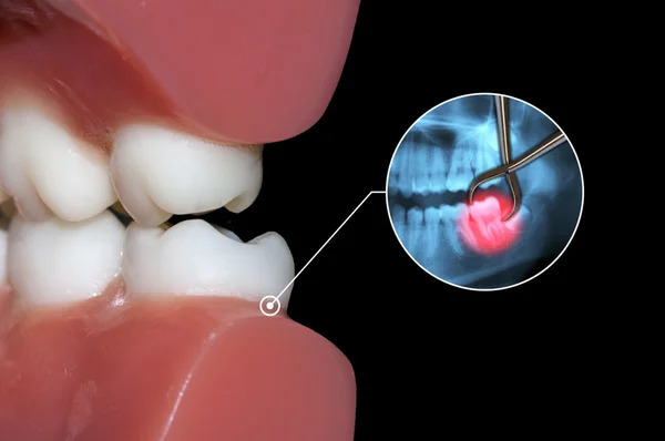 Cirurgia dentária dente extração operação — Fotografia de Stock