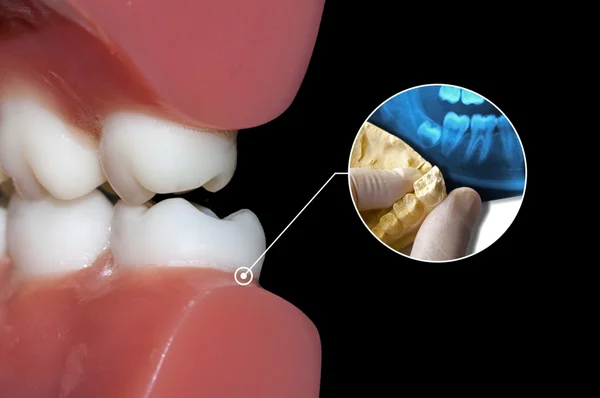 Diagnosi ascesso mal di denti dentista infografica — Foto Stock