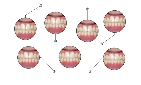 Infographic diş gülümseme belirtme çizgileri — Stok fotoğraf